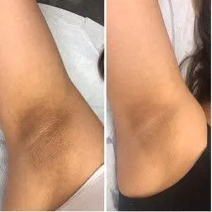 نمونه قبل و بعد روشن‌تر شدن پوست