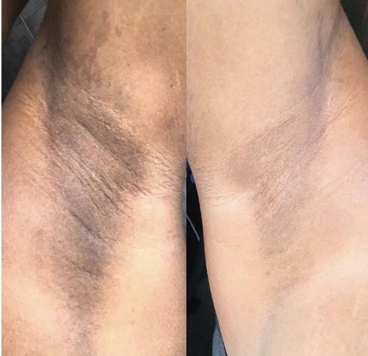 نمونه قبل و بعد پاکسازی پوست بینی