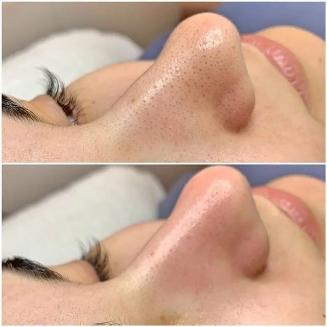 نمونه قبل و بعد پاکسازی پوست بینی
