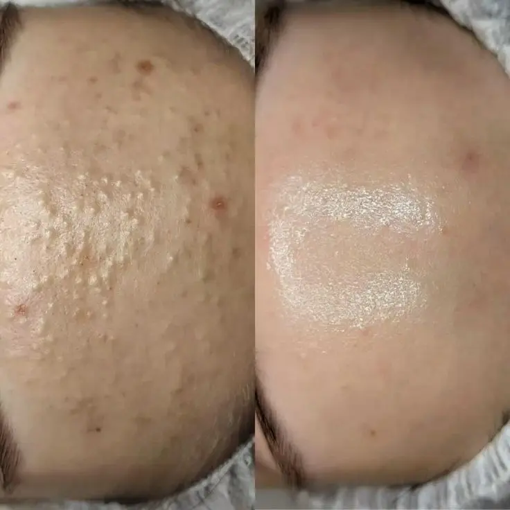 نمونه قبل و بعد بهبود ظاهر پوست صورت