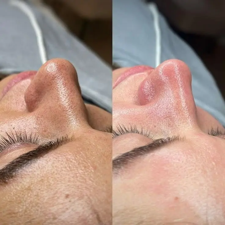نمونه قبل و بعد پاکسازی پوست بینی