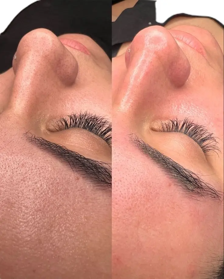 نمونه قبل و بعد پاکسازی و مراقبت پوست